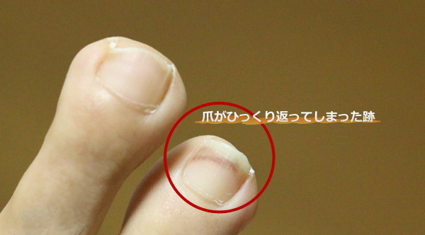 これが証拠写真。剥がしたのに、わずかに跡が残っているだけです。怪我をしたときには、爪がひっくり返っていたのです（痛）
